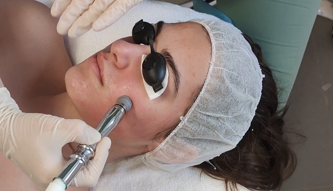 Лечение на акне – Адара