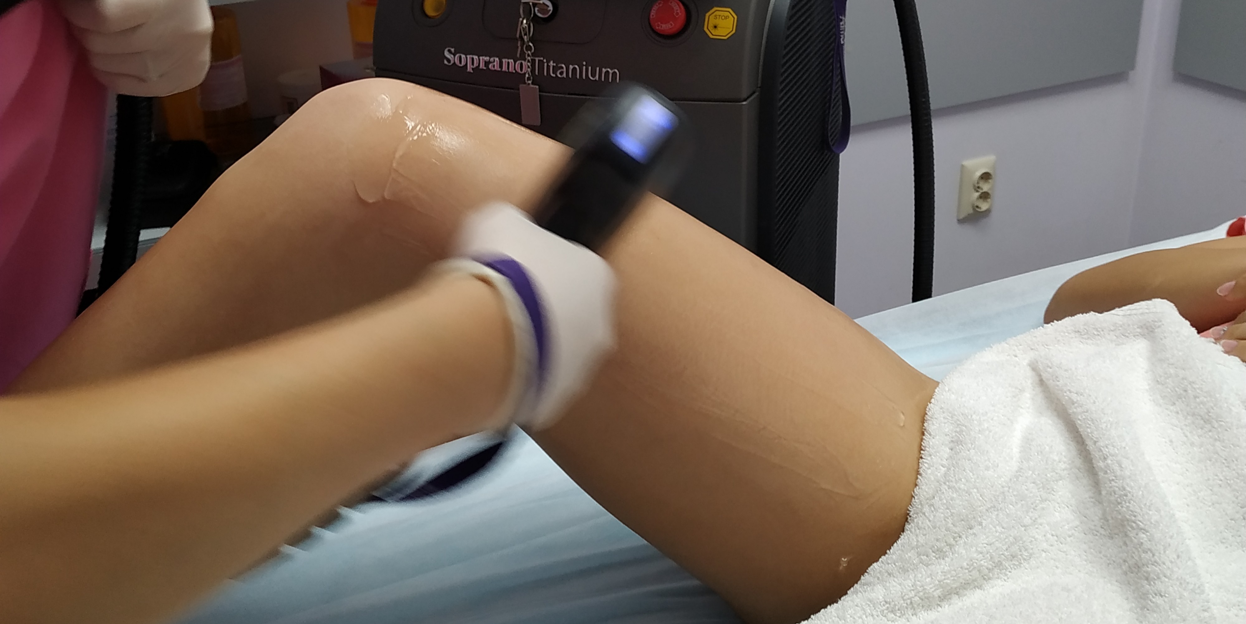 Лазерна епилация с Soprano Titanium