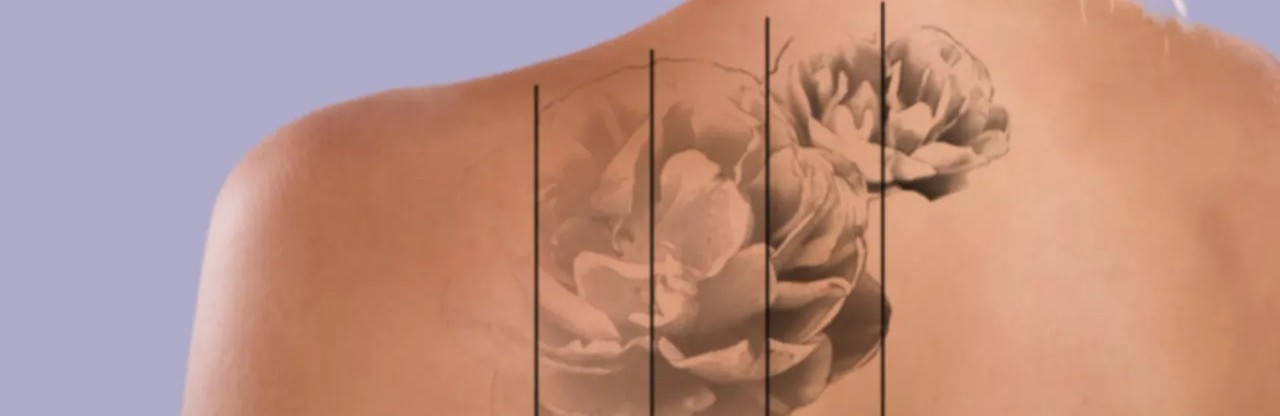 Премахване на татуировка с PicoHi лазер – Адара Русе